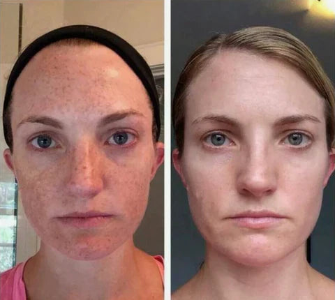 🔥suero corrector de manchas oscuras🥰🔥🔥