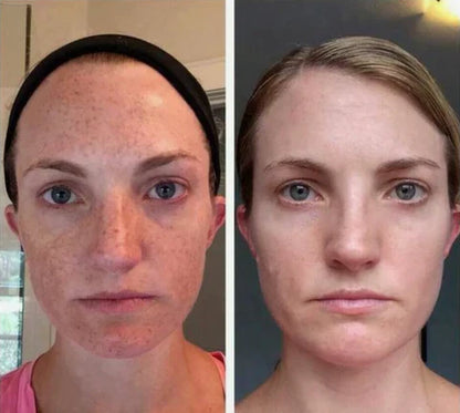 🔥suero corrector de manchas oscuras🥰🔥🔥