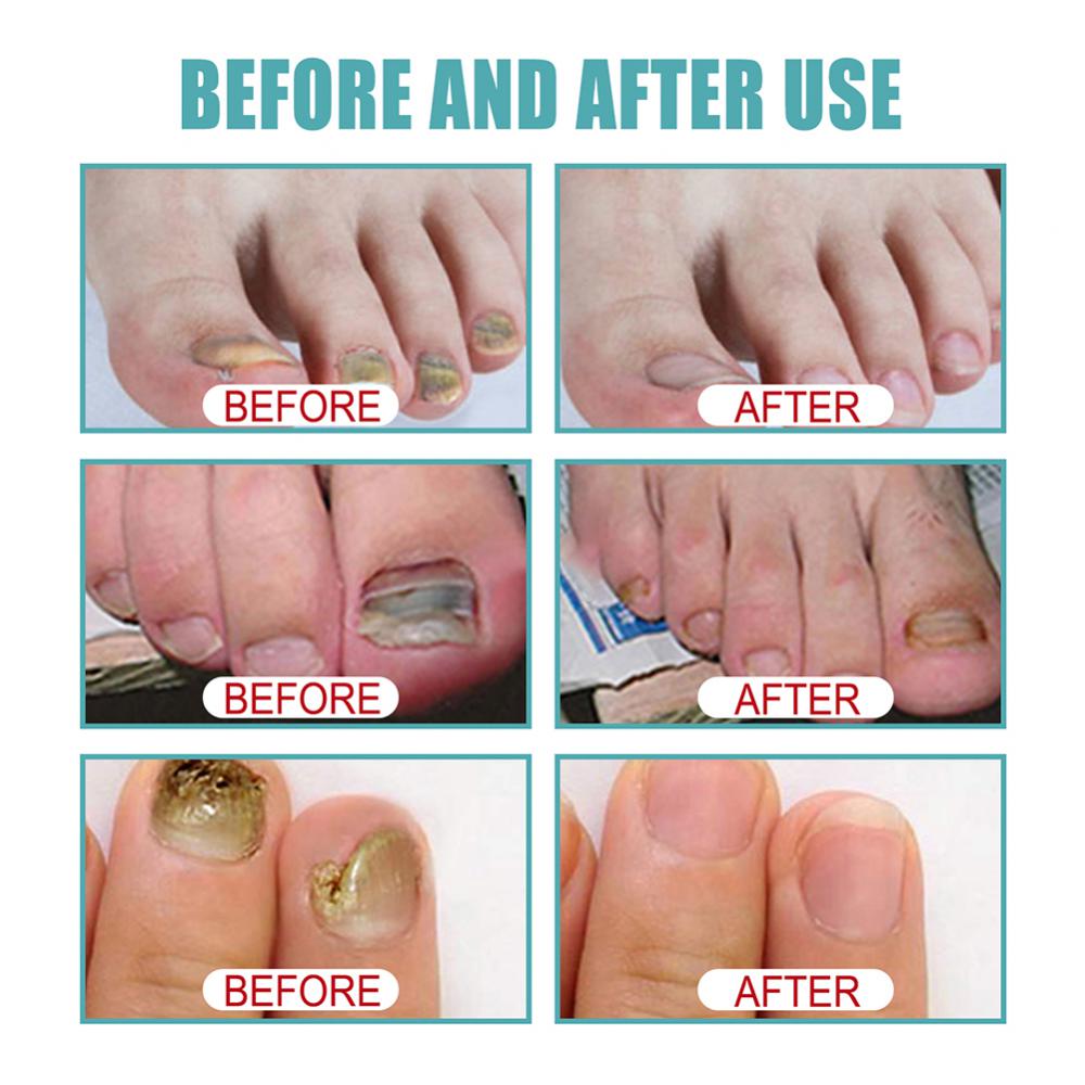 💅FUNGI BYE SPRAY🍃